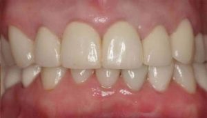 What Is Gingival Contouring? 